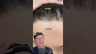 How I Got An INCREDIBLE Hairline Lowering Result [upl. by Lockwood]