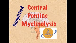 Central Pontine Myelinolysis Osmotic Demyelination Syndrome HYPONATREMIA in 6 min COMLEX USMLE [upl. by Ahseuqram]