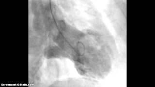 Takotsubo Cardiomyopathy LV Angiography [upl. by Riana]