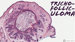 Trichofolliculoma Mother of All Hair Follicles 5Minute Pathology Pearls [upl. by Odlaniger830]