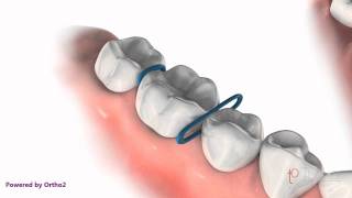 Orthodontic Spacers [upl. by Hoyt882]