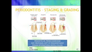 PERIODONTITIS STAGING amp GRADING [upl. by Olihs]