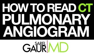 How to Read a CT Pulmonary Angiogram CTPA or PE Study [upl. by Guild]