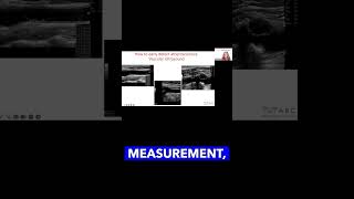 How vascular ultrasound allows to see different stages of atherosclerosis foryou [upl. by Gilbertson450]