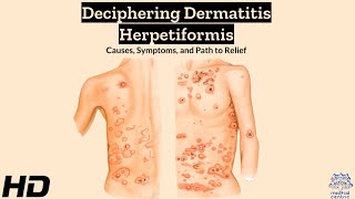 Dermatitis Herpetiformis Explained Symptoms Triggers and Relief [upl. by Hsitirb107]