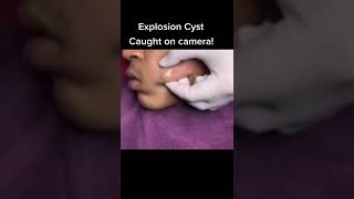 Cystic Acne Removal amp Inflammatory Acne [upl. by Casar]