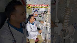 Leg Bones Fracture Healing Process trending viralvideo [upl. by Esya]