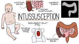 Understanding Intussusception [upl. by Amaryl538]