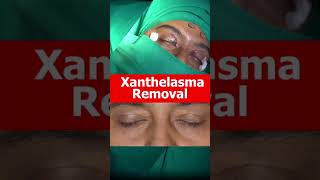 XANTHELASMA Removal Treatment At Shobhit Aesthetics [upl. by Barabbas]