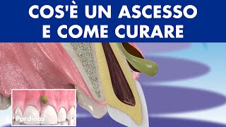 ASCESSO dentale  Cosè un flemmone e come CURARE linfezione dei denti © [upl. by Yrret]