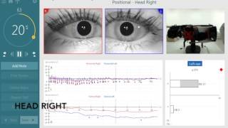 BPPV Assesment with the new TRV Chair by Interacoustics [upl. by Janna]