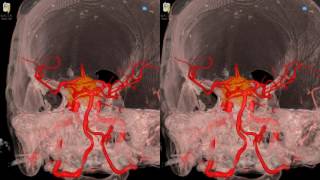 Cavernous Meningioma  3D Virtual Tour  UCLA Neurosurgery [upl. by Ahsiuqal427]