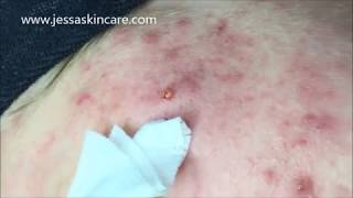 Acne Treatment Extractions  Acne Facial Protocol  Esthetician Education [upl. by Airamas]