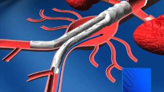 PREVENTIVE TREATMENT OF TYPE II ENDOLEAK WITH BIOMATERIALS PART 2Vascular Surgery [upl. by Ateinotna]