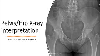 PelvisHip Xray interpretation [upl. by Kassey]