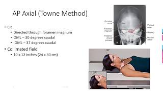 Radiographic Positioning of the Skull [upl. by Mani]