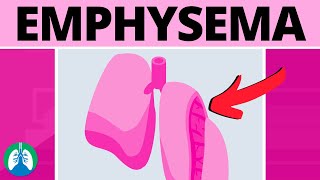 Emphysema Medical Definition  Quick Explainer Video [upl. by Nur]