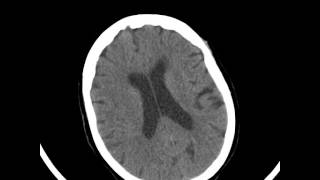 Brain atrophy in elderly  Head CT [upl. by Jangro]