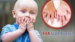 genetic disease ichthyosis vulgaris treatment videos fish scale disease treatment [upl. by Lorene]