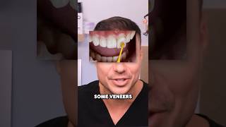 Dont Make This MISTAKE After Getting Veneers 🤢🦷 [upl. by Derick]