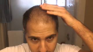 Hair Transplant Review 2013 60 days Post Op [upl. by Karas]