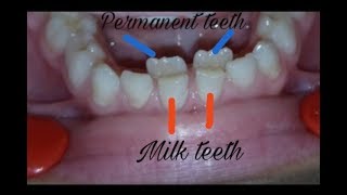 Over retained deciduous teeth milk teeth extraction  dental issues [upl. by Adiol]