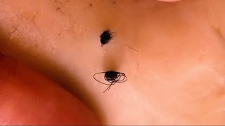 Removal of ingrown hair [upl. by Petracca699]