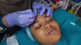 TREATMENT ACNE PEELING GLAMMY BEAUTY CLINIC  TREATMENT ACNE PEELING TERMURAH [upl. by Etnuad]