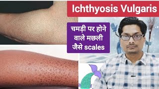 चमड़ी पर होने वाले मछली जैसे scales  Ichthyosis Vulgaris  Itchy dry fish like skin ichthyosis [upl. by Trubow]