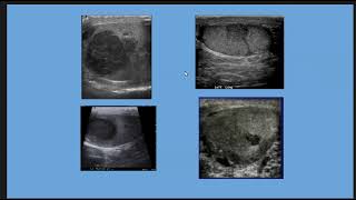 Ultrasound Imaging of Testicular Masses Overview [upl. by Sunda]