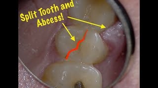 Split Tooth Root Fracture  Diagnosis including transillumination this time [upl. by Kaitlynn]