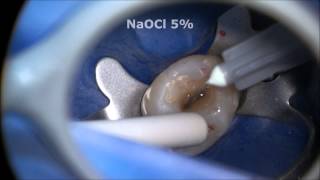 Endodontic Access and Root Canal Preparation explained [upl. by Elata]