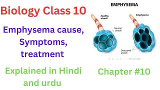 Emphysema Cause Symptoms Treatment Chapter 10 Biology Class 10 Explained in Hindi and urdu [upl. by Vookles842]