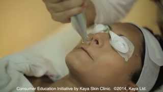 Kaya Q Switch Insta Clarity Laser  Get Rid of Acne and Uneven Skin [upl. by Korey374]