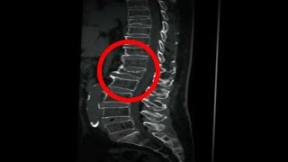 L1 first Lumbar Body Compression Fracture Causes Symptoms And Treatment [upl. by Gault]