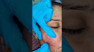 SUBCISION WITH MICRO NEEDLING RF FOR ACNE SCAR [upl. by Ricoriki]