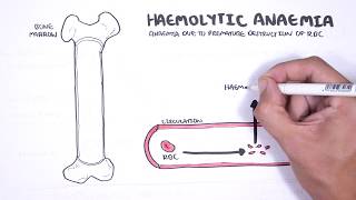 Haemolytic Anaemia  classification intravascular extravascular pathophysiology investigations [upl. by Roydd204]