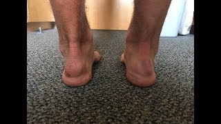 Training for Western States The epic story of my Achilles [upl. by Upali]