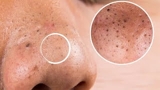 How to remove blackheads and Whiteheads from nose and face naturally at home [upl. by Dlanor]