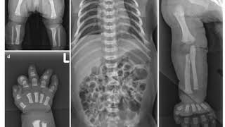 Case 0087 Achondroplasia [upl. by Katina]