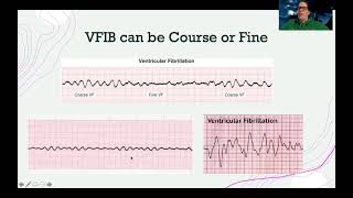 EKGVentricular Dysrhythmias [upl. by Leia]