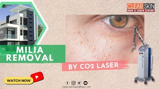 ACNE Treatment At Home  3 day Acne REMOVAL Challenge  Acne Treatment Ayurvedic with Results [upl. by Aillil]