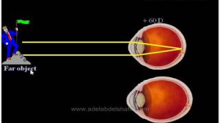 Errors of refraction for undergraduates  Introduction [upl. by Agretha]