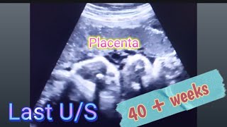 Baby BOY placenta position gender prediction  Anterior Placenta baby gender  how to reveal gender [upl. by Yhtomit]