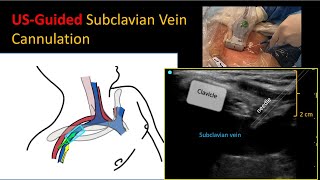 Ultrasoundguided subclavian vein cannulation – How I Do It [upl. by Neelyam]