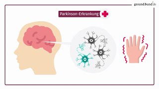 Was ist die ParkinsonErkrankung [upl. by Nawed]