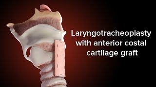 Medical Animation Anterior Cricoid Split  Cincinnati Childrens [upl. by Briscoe]