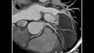 Cardiac Right Coronary Artery 1 of 7 [upl. by Alihs430]