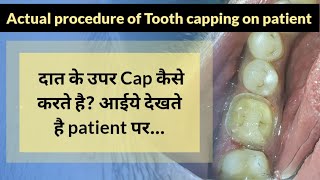 आईए देखते है Tooth Capping कैसे करते है l Tooth Capping Procedure on patient [upl. by Eiba]