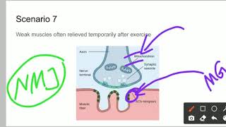 Paraneoplastic syndromes of lung cancer [upl. by Adnuhsar]